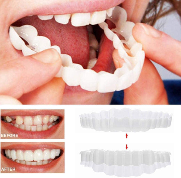 Snap-On Tanden Facings (Inclusief Boven- en Onderkaak)